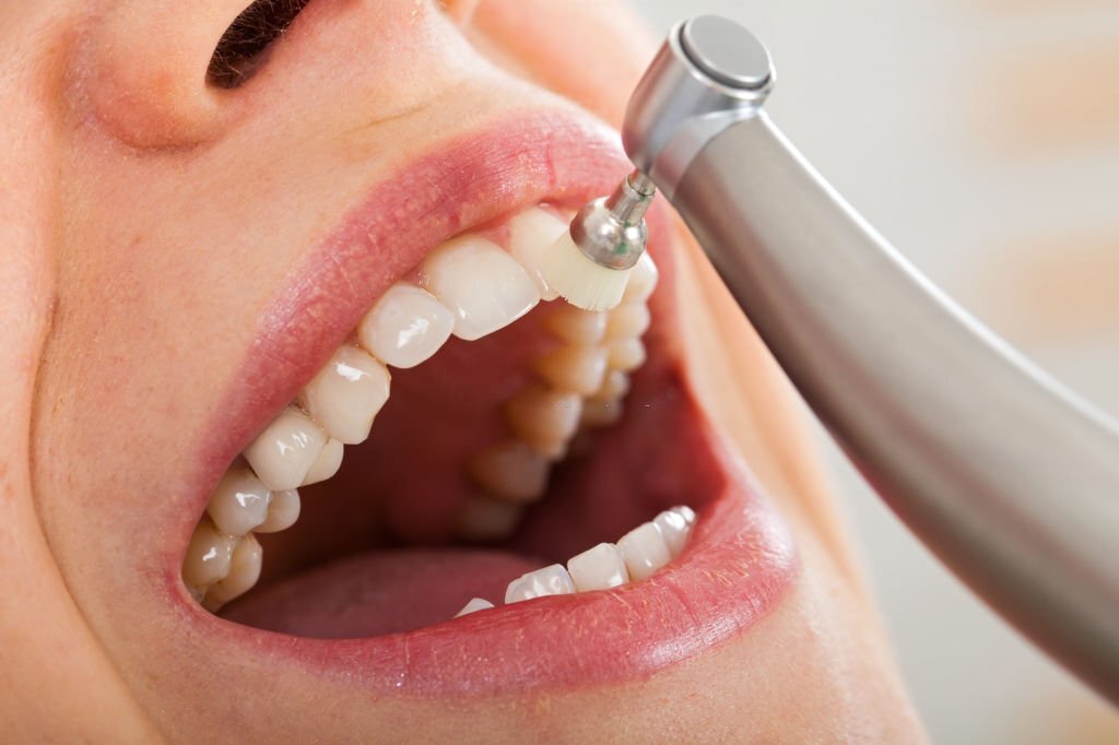 Teeth Cleaning in Bodrum – Dental Cleaning