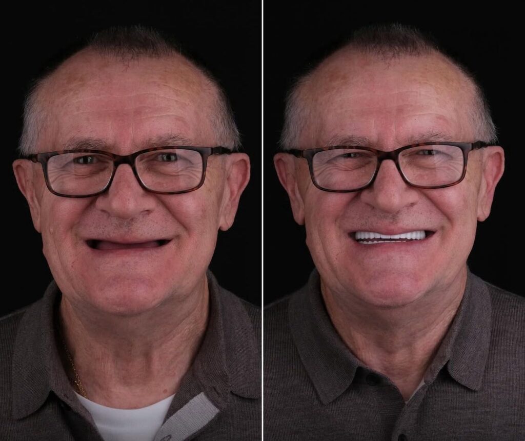 Full-Mouth Dental Restoration