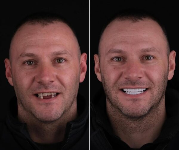 12 Dental Implants in Bodrum