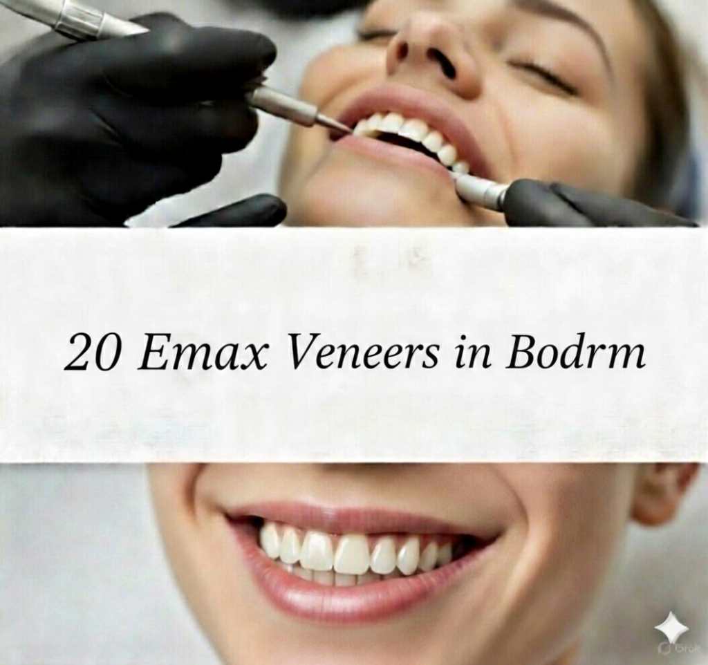20 Emax Veneers in Bodrum