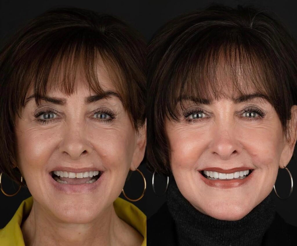 20 Emax Veneers in Bodrum